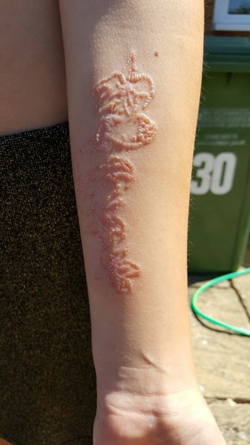 Girl could be scarred for life after black henna tattoo goes horribly wrong