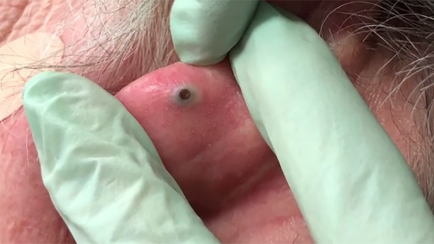 Dr Popper extracting this blackhead the size a pebble the most satisfying thing you'll see all week!
