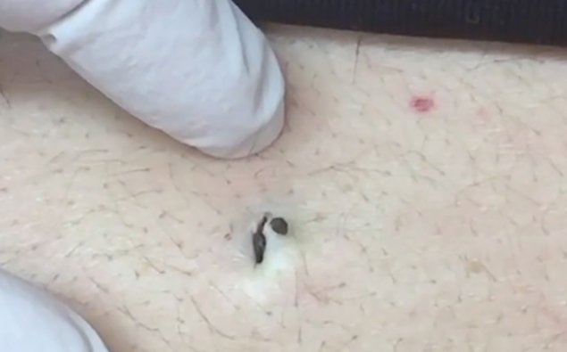 Dr Pimple Popper Extracting This Blackhead The Size Of A